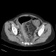 Ulcerative colitis of left colon, enterography: CT - Computed tomography